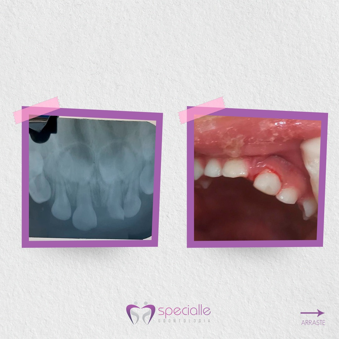 TRAUMATISMO DENTÁRIO
